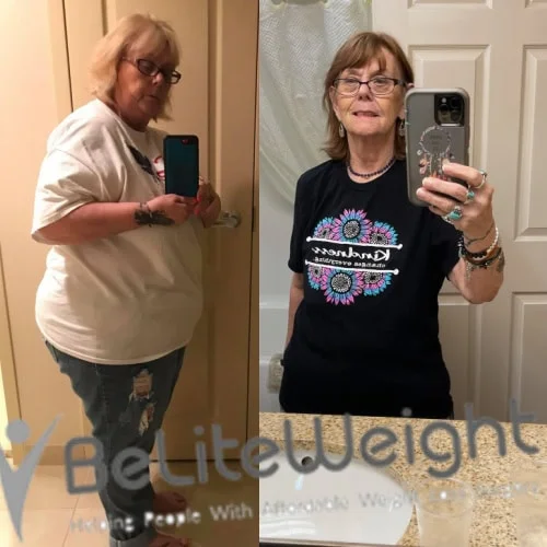 Weight Loss Surgery Before And After